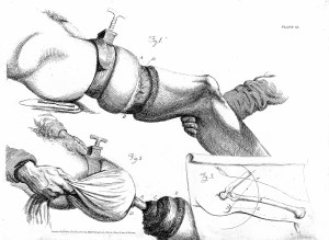 L0001337 Amputation of the thigh, 19th century Credit: Wellcome Library, London. Wellcome Images images@wellcome.ac.uk http://wellcomeimages.org Amputation of the thigh, 19th century 1820 Illustrations of the Great Operations of Surgery Bell, Sir Charles Published: 1820 Copyrighted work available under Creative Commons Attribution only licence CC BY 4.0 http://creativecommons.org/licenses/by/4.0/